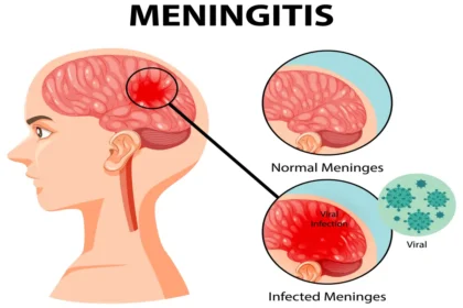 Bacterial Meningitis Can Cause Brain Damage in Children Study Warns